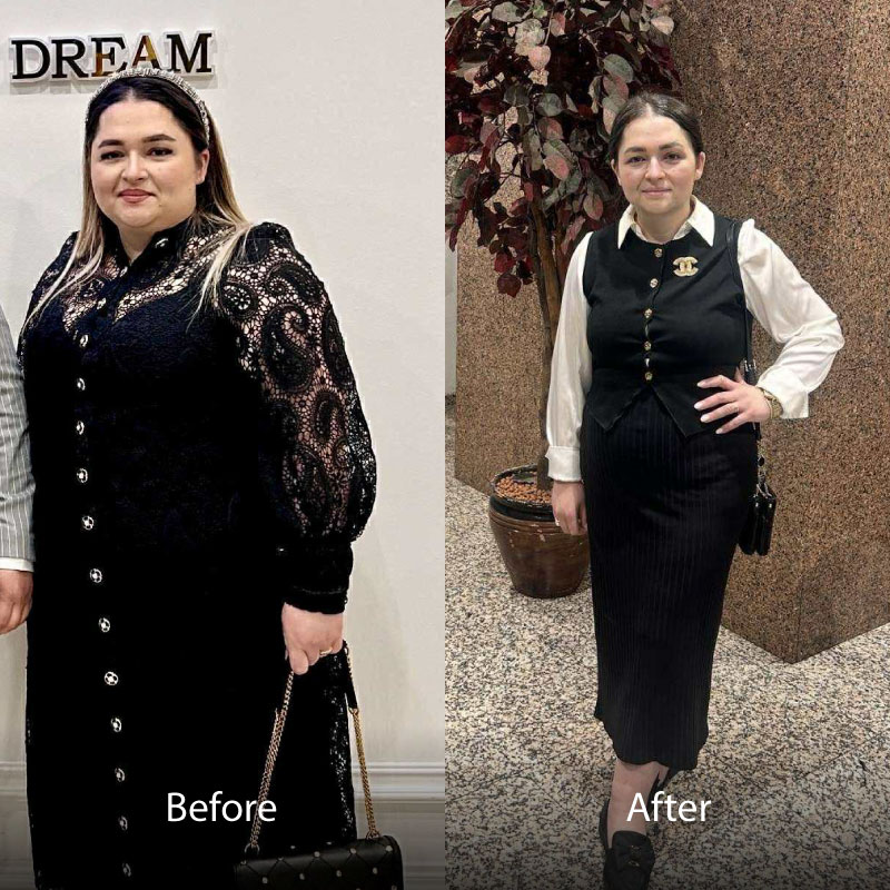 Aselie-BA-Gastric-Sleeve-01