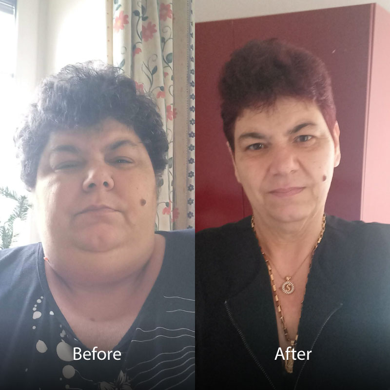 Aselie-BA-Gastric-Sleeve-02