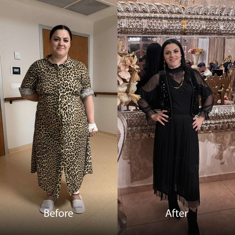 Aselie-BA-Gastric-Sleeve-03
