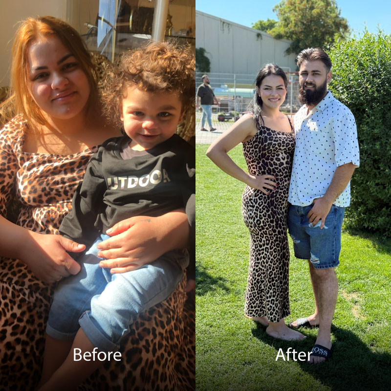 Aselie-BA-Gastric-Sleeve-05