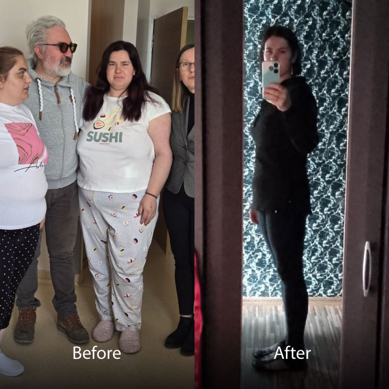 Aselie-BA-Gastric-Sleeve-06